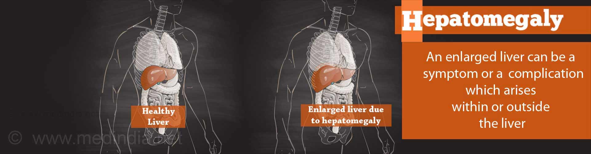 hepatosplenomegaly-causes-complications-and-treatment