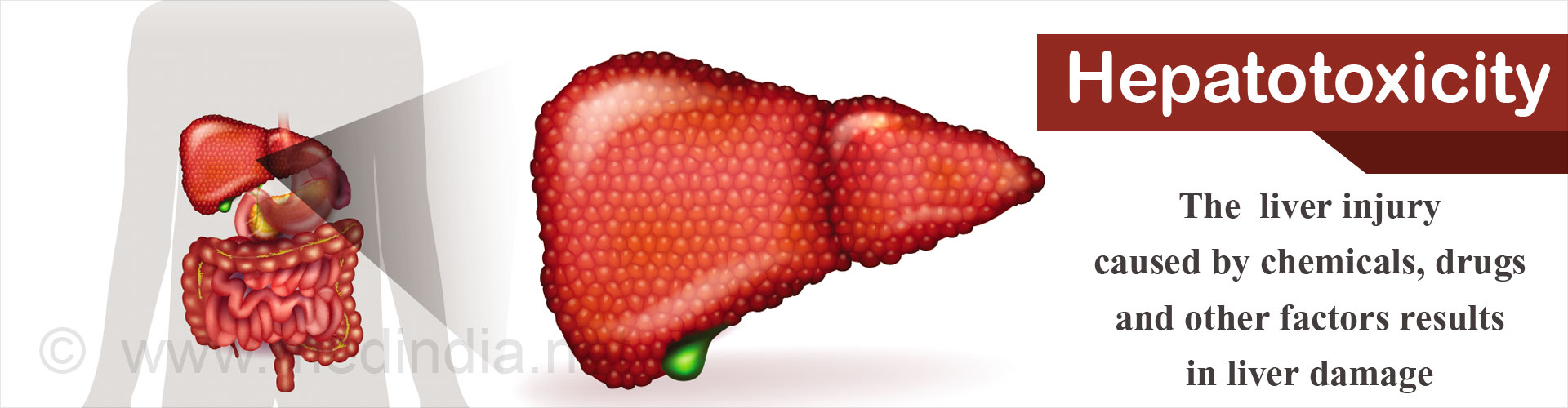 hepatotoxicity-due-to-drugs-causes-symptoms-diagnosis-treatment