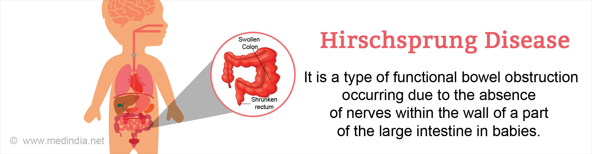 Hirschsprung Disease | Congenital Megacolon - Causes, Symptoms