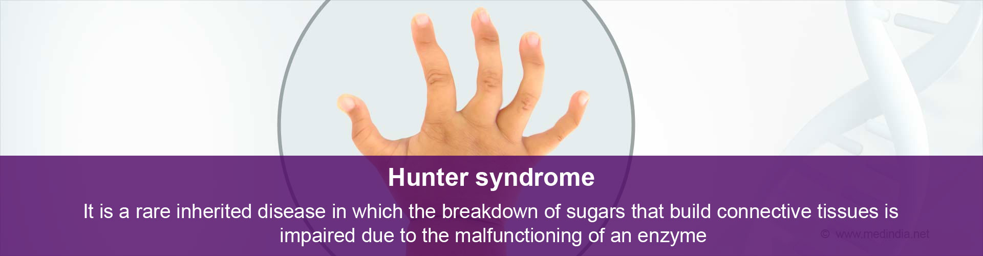 hunter-syndrome-causes-symptoms-diagnosis-treatment-prevention