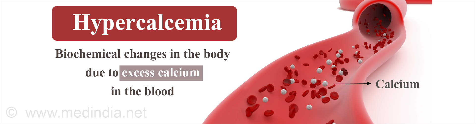 hypercalcemia-causes-symptoms-risk-factors-diagnosis-treatment