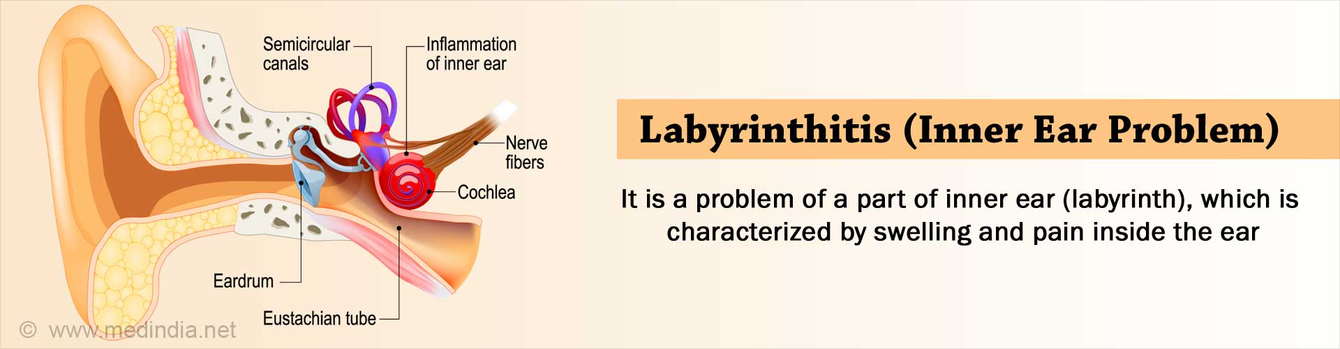 labyrinthitis-symptoms-causes-diagnosis-treatment-prognosis