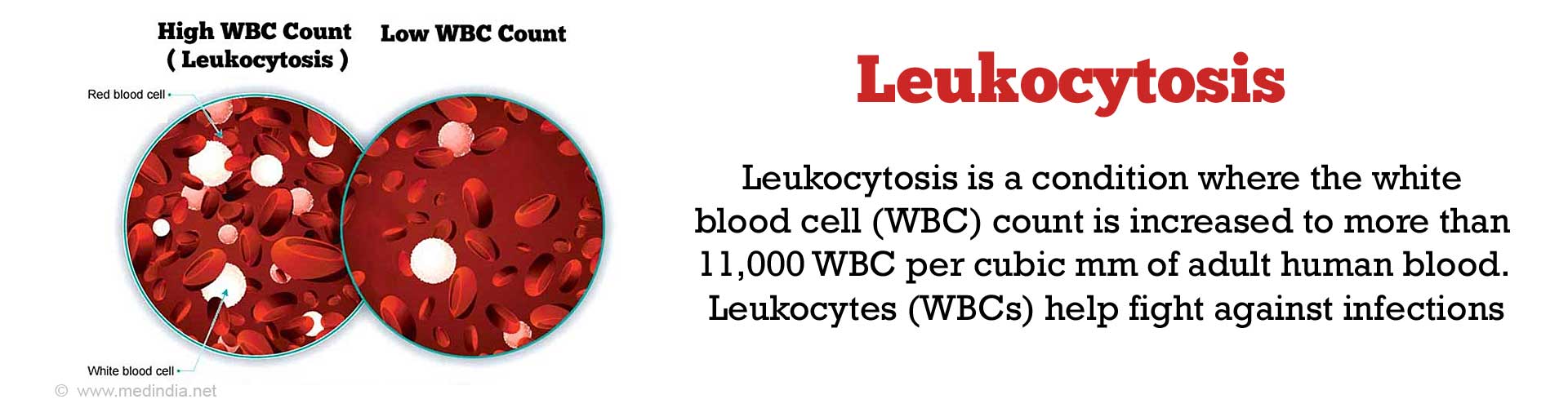 Leukocytosis Causes Symptoms Diagnosis Treatment