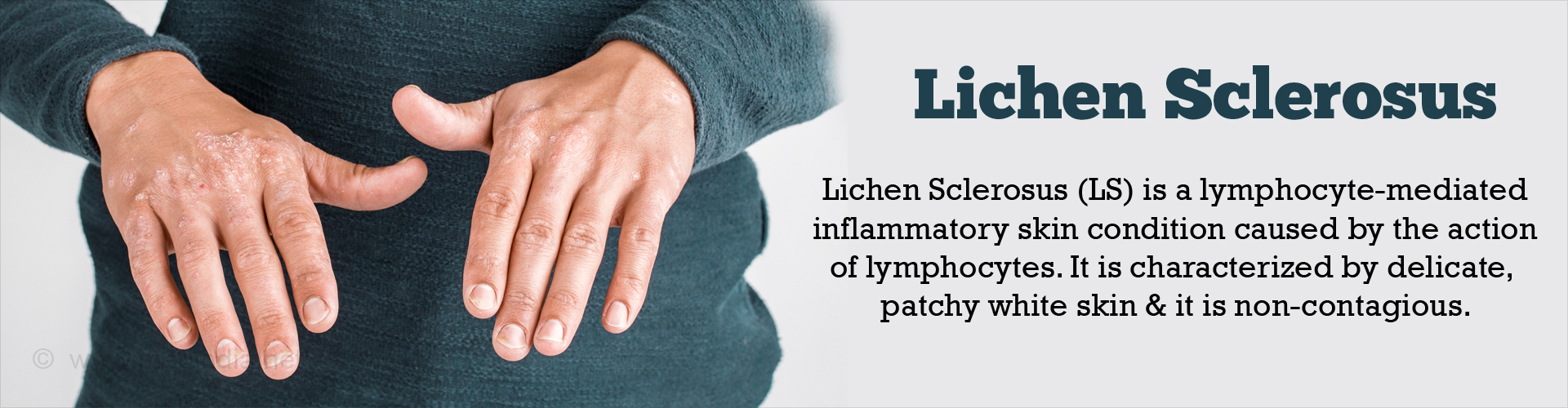 Lichen Sclerosus Causes Symptoms Diagnosis Treatment