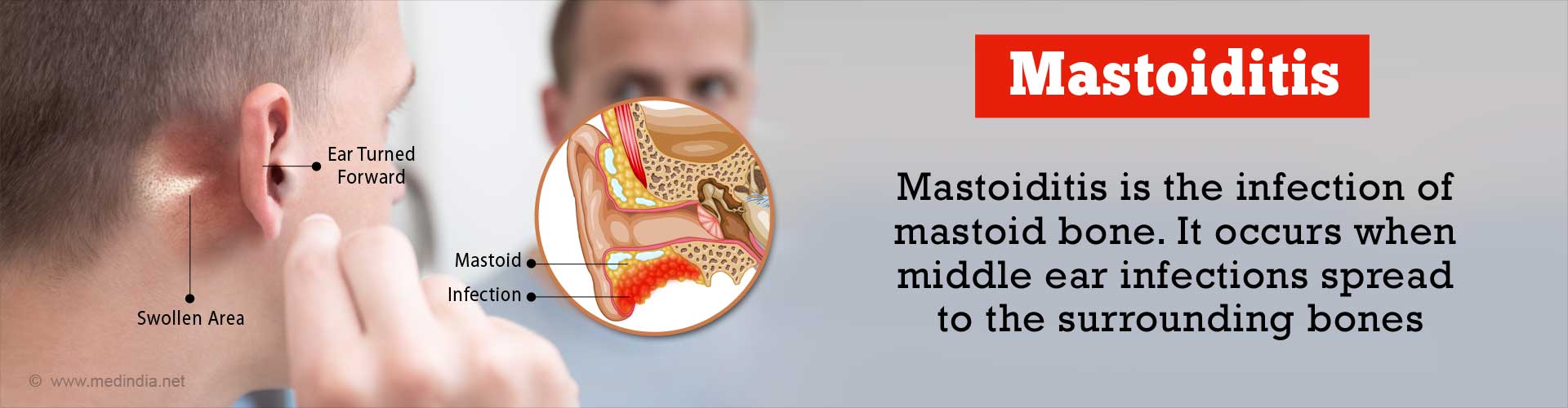 Mastoiditis - Causes Symptoms Diagnosis Complications and Treatment