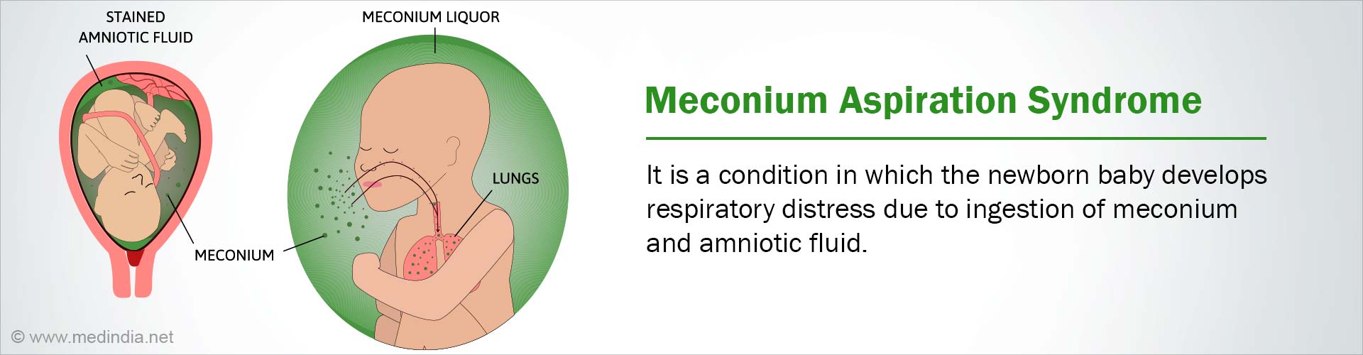 Meconium Aspiration Syndrome Anatomy