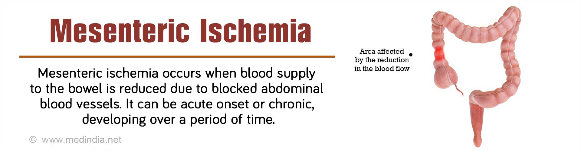 Mesenteric Ischemia - Causes, Symptoms, Diagnosis and Treatment