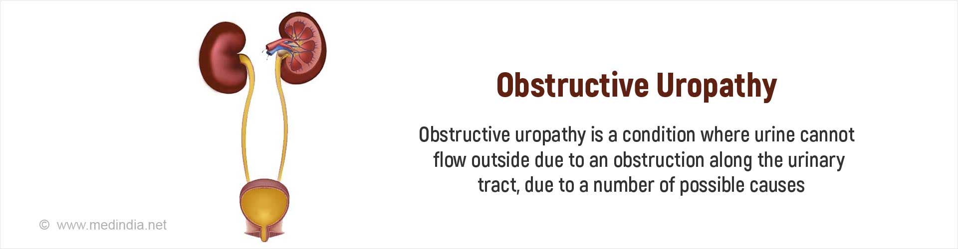 obstructive-uropathy-causes-symptoms-diagnosis-treatment-prevention