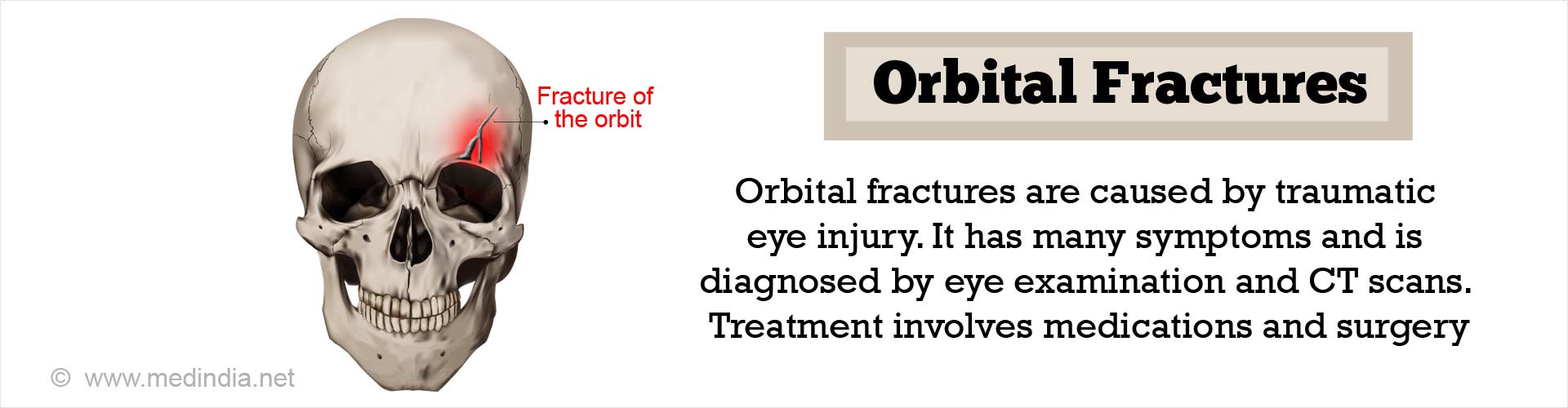 orbital-fractures-fractures-of-the-orbit-eye-socket-fractures