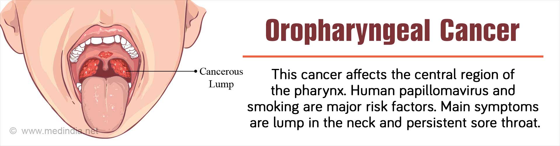 oropharyngeal-cancer-causes-symptoms-diagnosis-treatment