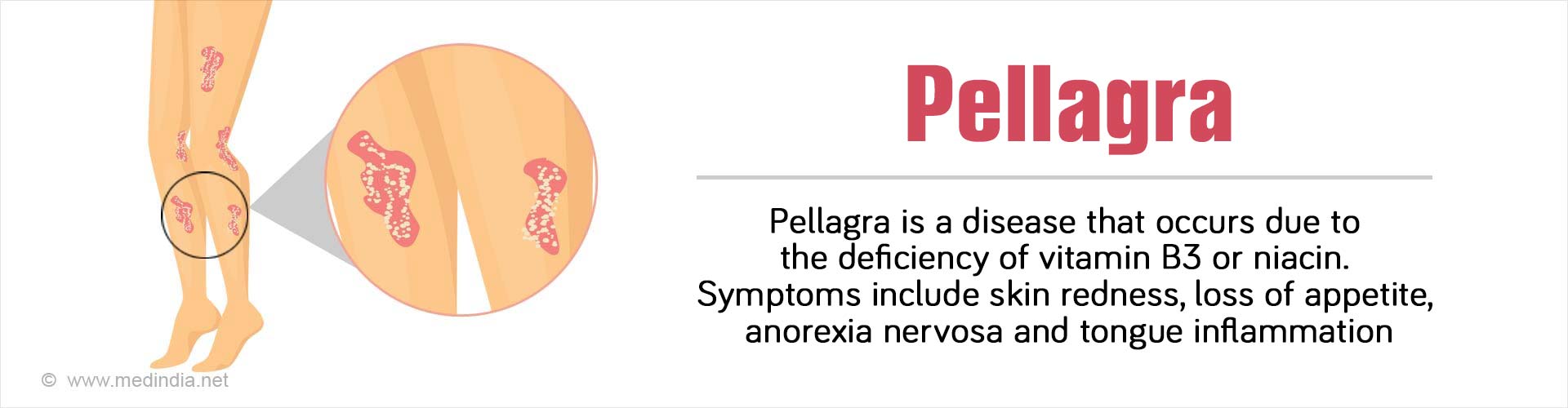 pellagra-causes-symptoms-diagnosis-treatment-and-complications