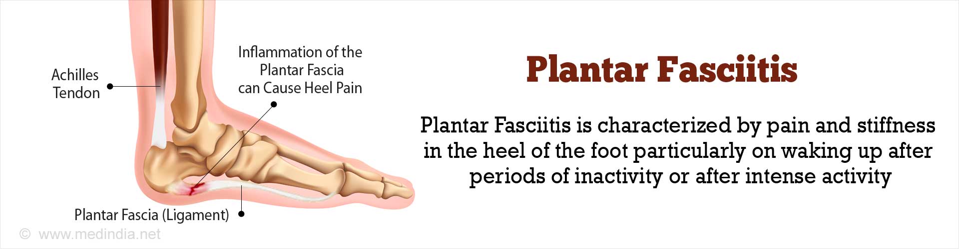 Plantar Fasciitis - Causes, Symptoms, Diagnosis, Treatment