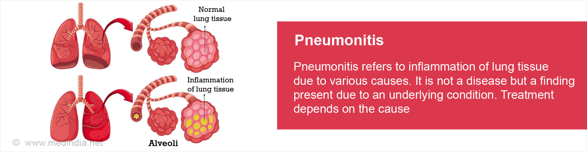 pneumonitis-non-infective-inflammation-of-lung