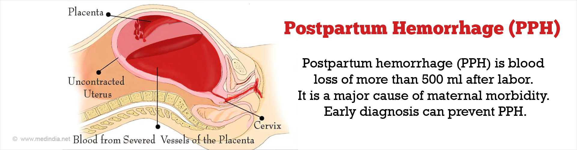 How Does Postpartum Hemorrhage Happen