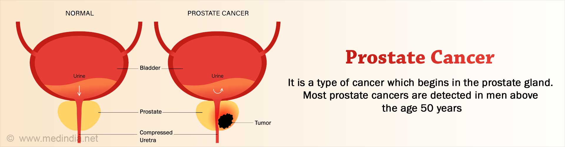 Medical Management of Prostate Cancer