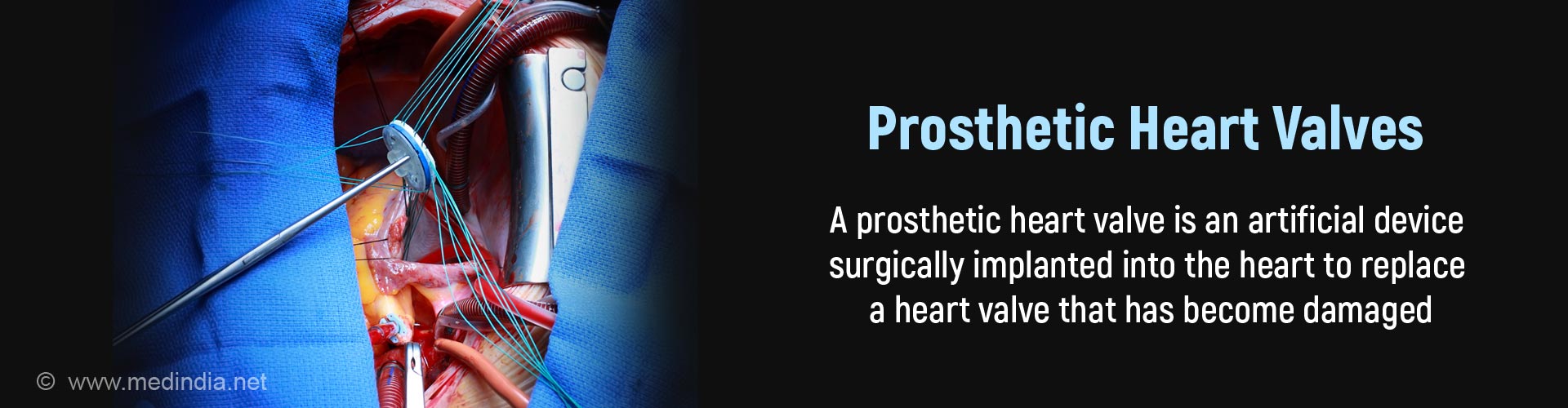 How Long Does A Prosthetic Heart Valve Last