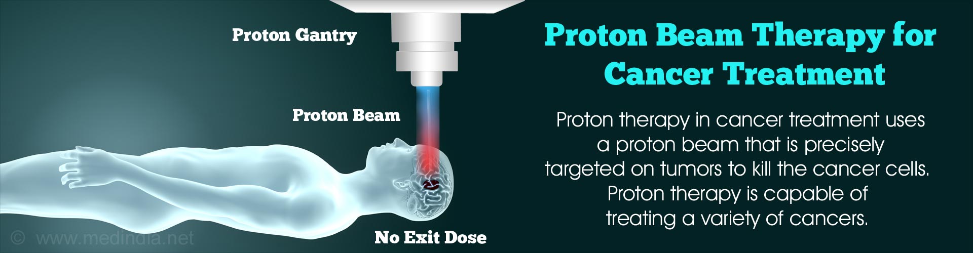 Prostate Cancer Proton Beam Therapy 1171