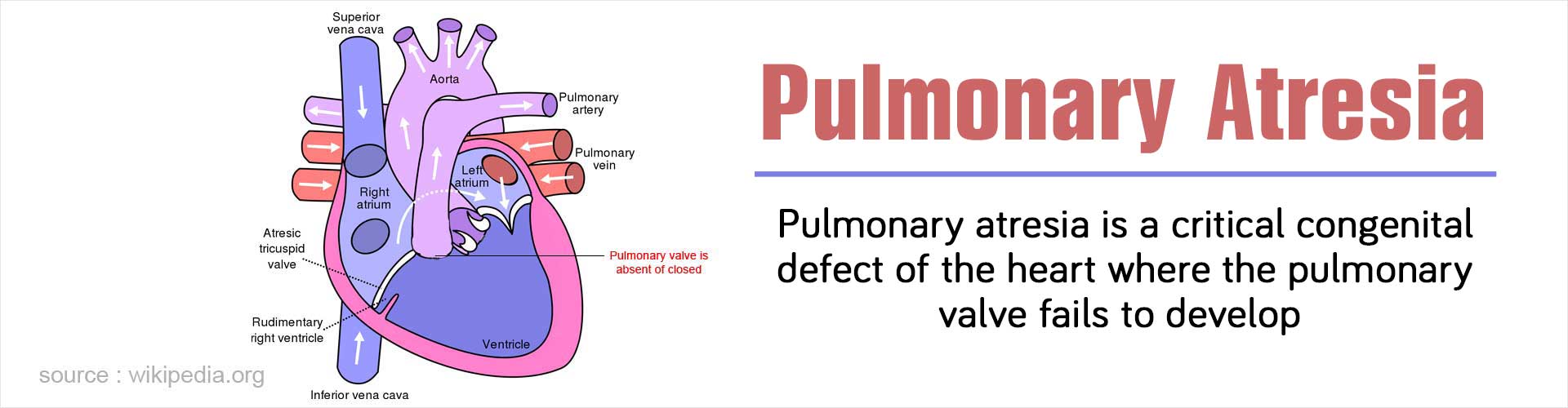 Pulmonary Atresia - Types, Symptoms, Diagnosis and Management