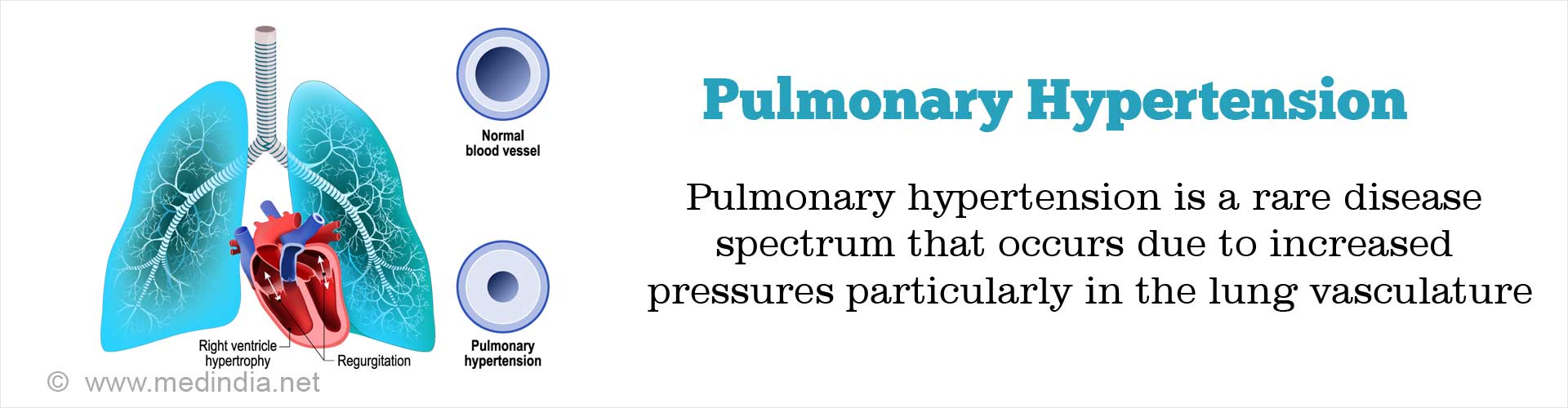 Pulmonary Hypertension