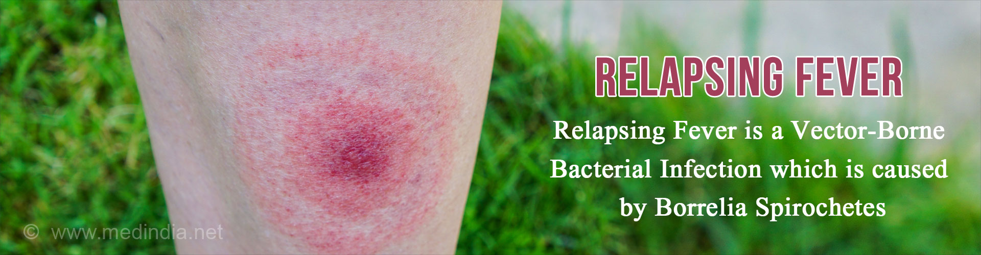 relapsing-fever-causes-symptoms-complications-diagnosis-treatment