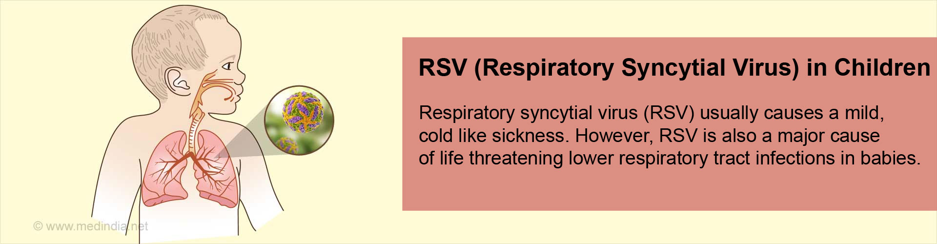 RSV (Respiratory Syncytial Virus) in Children