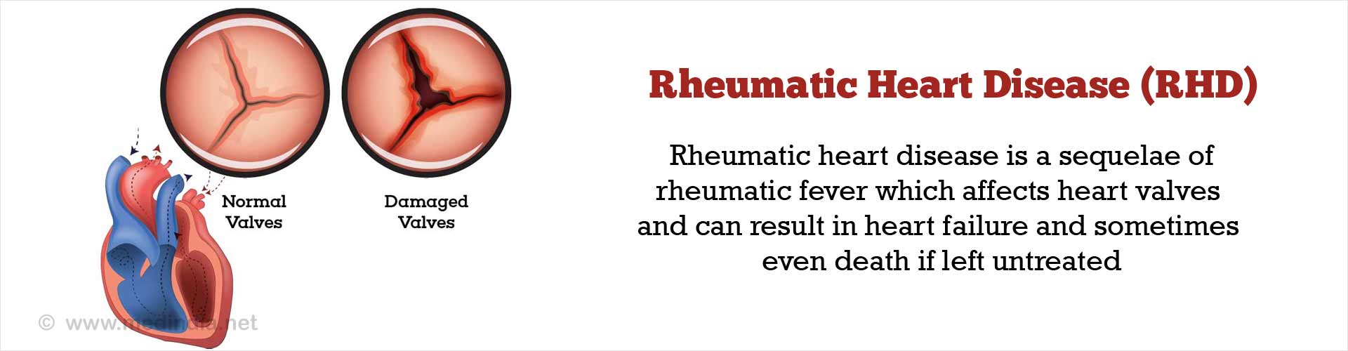 Signs And Symptoms Of Rheumatic Heart Disease In Pregnancy