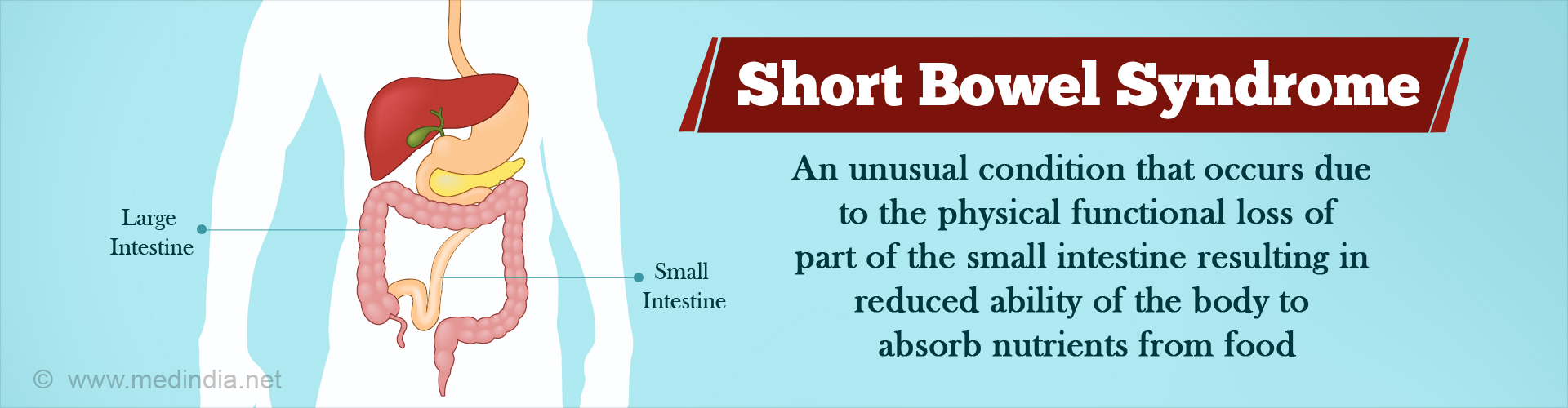 Short Bowel Syndrome Causes Symptoms Complications Diagnosis 