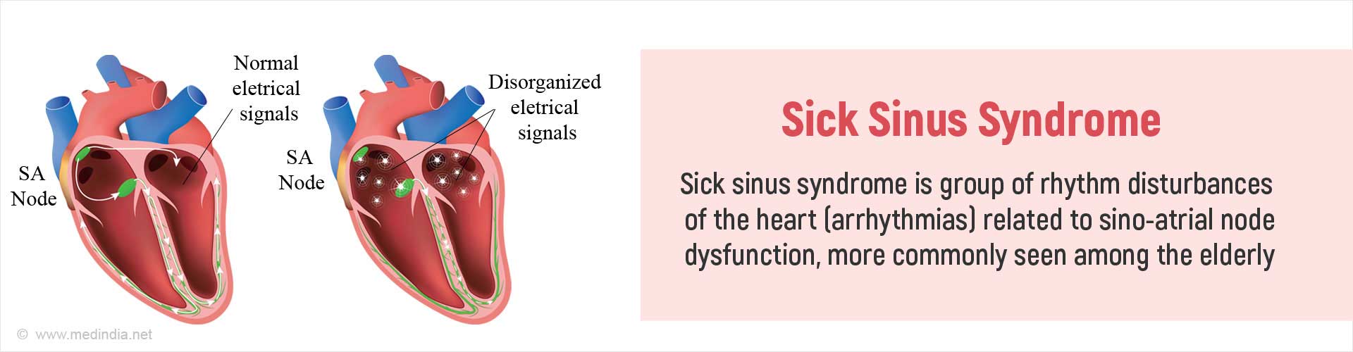 diagnosis and treatment of sick sinus syndrome