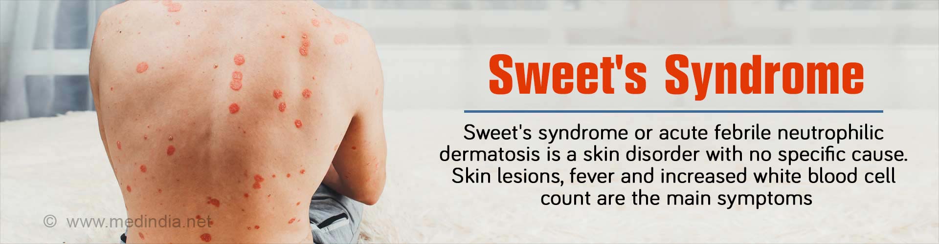 Sweet’s Syndrome Causes, Clinical Features, Diagnosis and Management