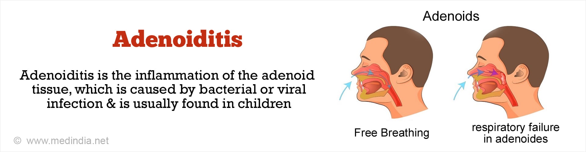 Adenoids | Adenoiditis - Causes, Symptoms, Complications, Diagnosis ...