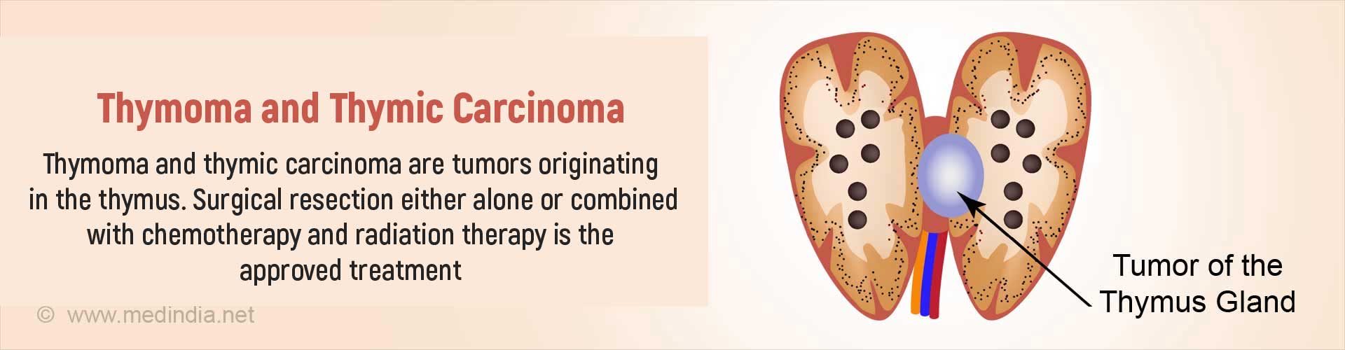 Thymus Gland Cancer Symptoms