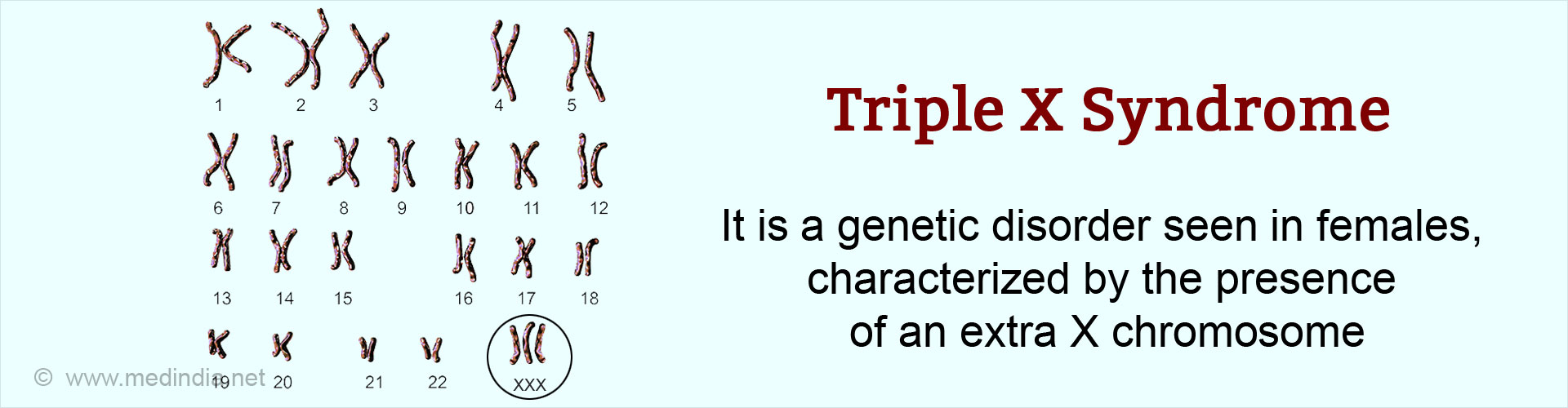 triple-x-syndrome-causes-symptoms-diagnosis-treatment-prevention