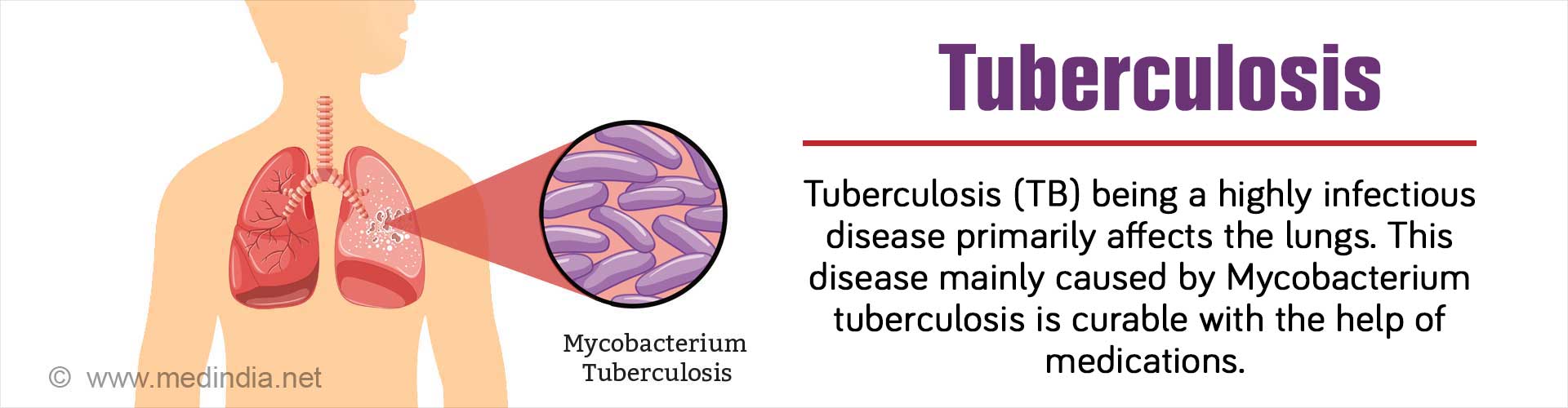 Tuberculosis - Spread - Symptoms - Diagnosis - Treatment - FAQs