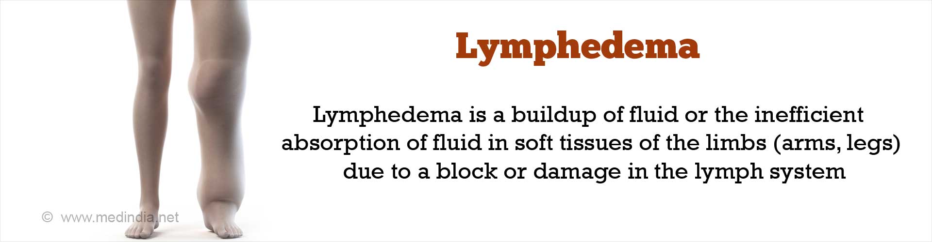 Lymphedema Types Causes Symptoms Diagnosis Treatment