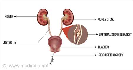 Ureteroscopy For Stone