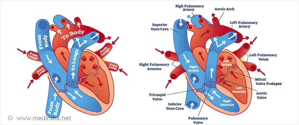 Mitral Valve Prolapse Syndrome