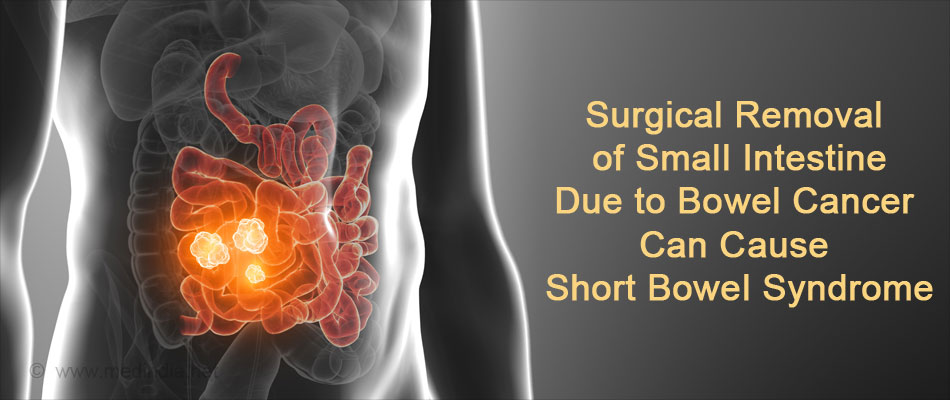 Short Bowel Syndrome - Causes, Symptoms, Complications, Diagnosis ...