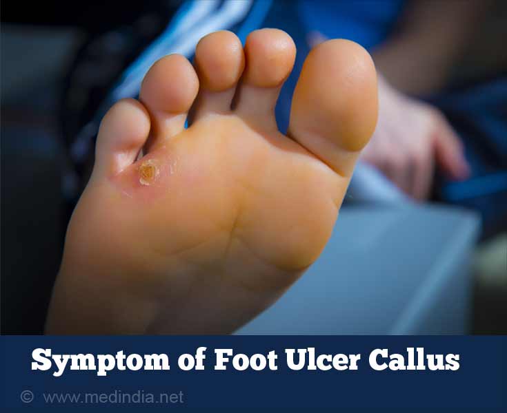 1 ulcer treatment stage skin Treatment   & Symptoms, Ulcer Prevention Causes, Foot Types,