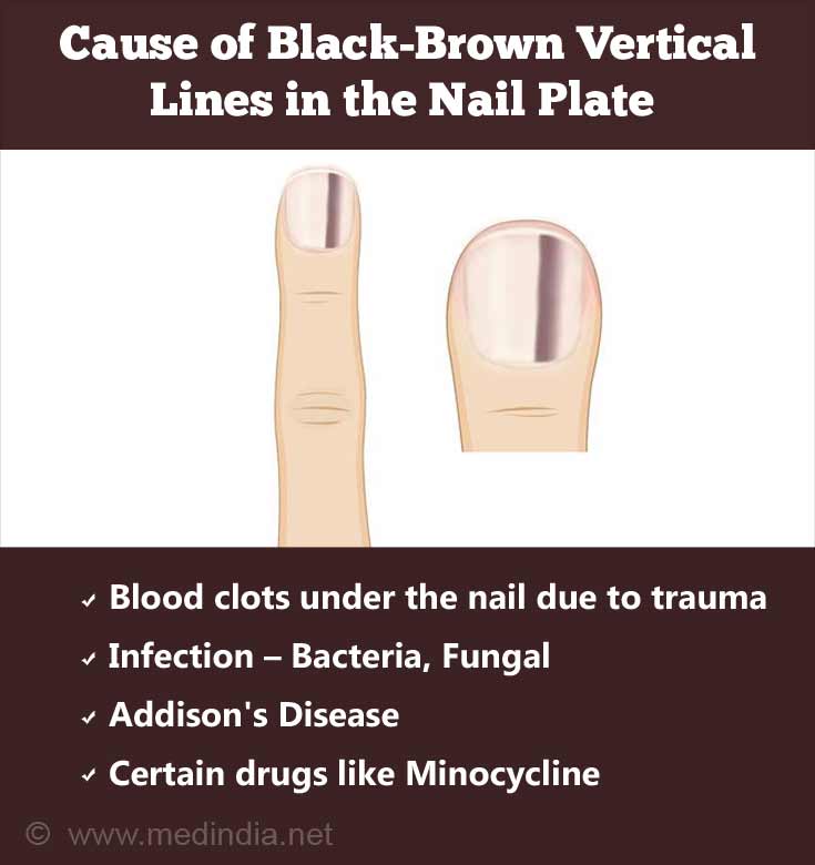 Subungual Melanoma Fingernail Cancer Causes Symptoms Diagnosis 