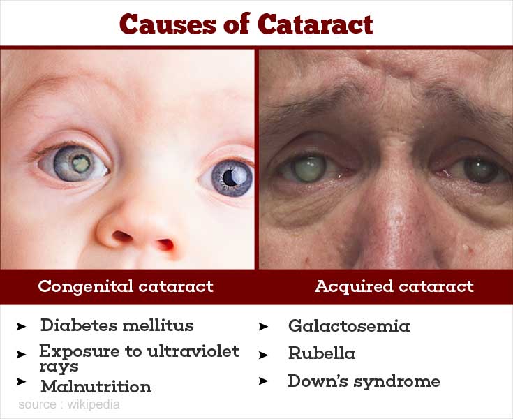 Cataract Causes Symptoms Diagnosis Treatment And Prevention 