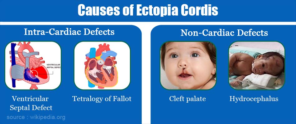 Ectopia Cordis - Causes, Symptoms, Diagnosis, Complications, Treatment ...