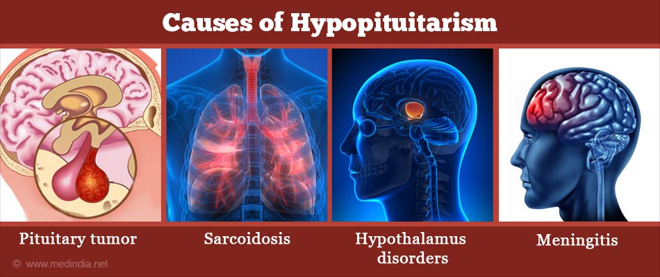 Hypopituitarism Causes Symptoms Diagnosis Treatment And Prevention 8092