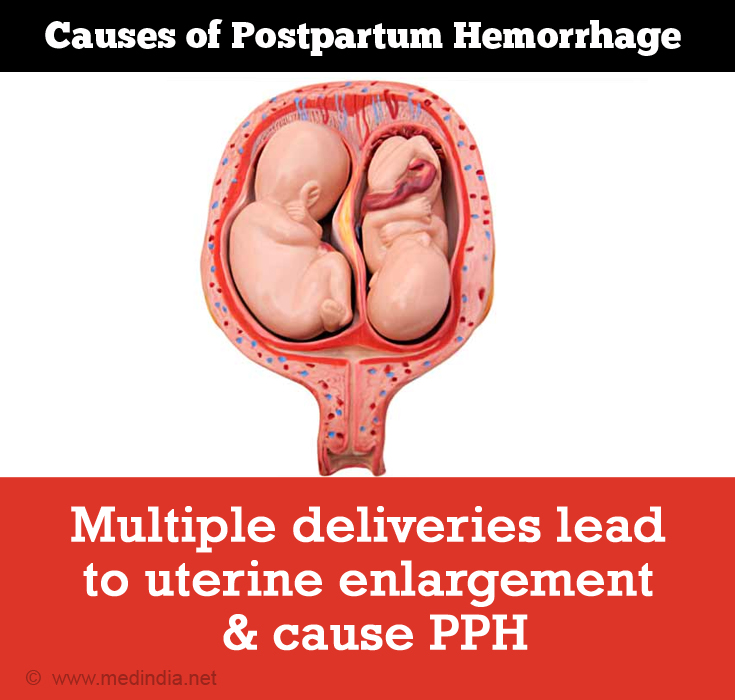 Multiple Deliveries Cause Postpartum Hemorrhage