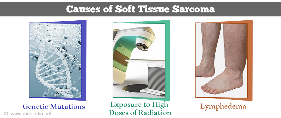 Soft Tissue Sarcoma - Types, Causes, Symptoms, Diagnosis, Treatment ...