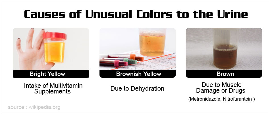 urine causes does colors cause colored odor unusual orange brown nitrofurantoin drugs metronidazole