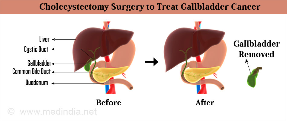 Gallbladder Cancer - Types, Causes, Symptoms, Diagnosis ...