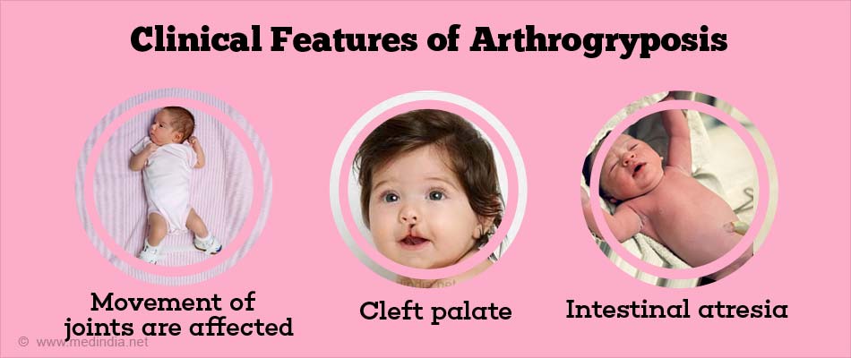 Clinical features of Arthrogryposis