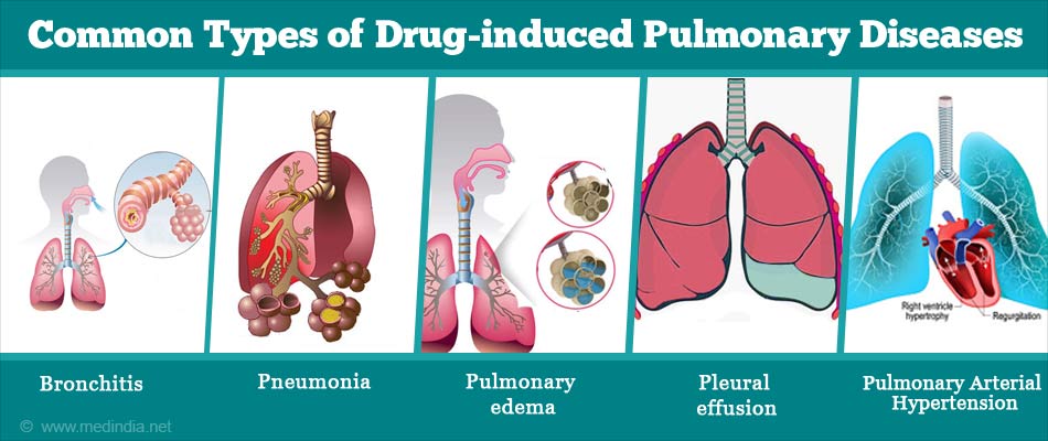 Drug-induced Pulmonary Diseases - Types, Symptoms and Treatment