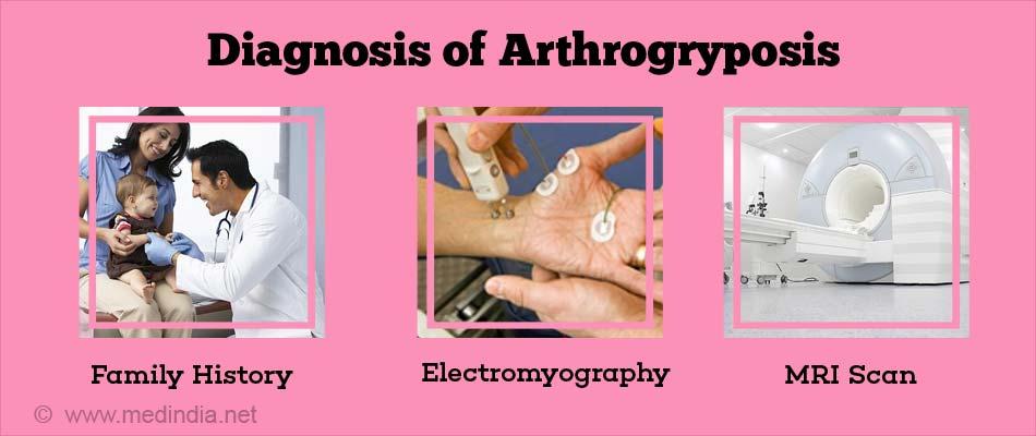 Diagnose of Arthrogryposis