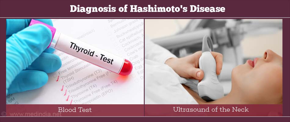 hashimoto-s-thyroiditis-risk-factors-types-causes-symptoms